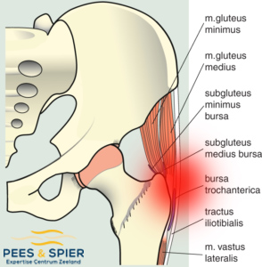 Slijmbeursontsteking-heup-slijmbeurs-ontsteking-behandeling-Pees-en-Spier-Zeeland-Goes