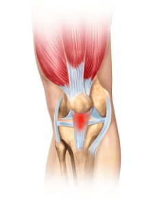 Kniepees-ontsteking-Jumpers-Knee-pees-en-spier-Zeeland-behandeling-oefenen-therapie