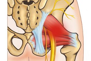 Piriformis-syndroom-pees-en-spier-Zeeland-Goes-Behandelingen-behandelen-therapie