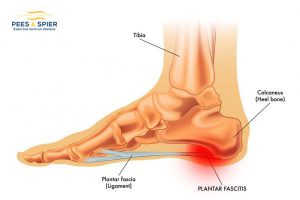 voetpijn-Fascia-plantaris-tendinopathie