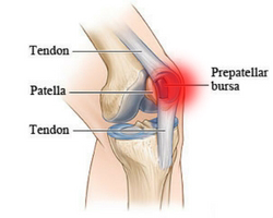 slijmbeursontsteking-knie-ontsteking-behandeling